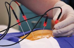 PRF pain treatment